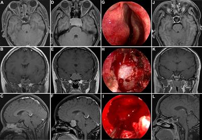 Outcome of Endoscopic Transsphenoidal Surgery for Recurrent or Residual Pituitary Adenomas and Comparison to Non-Recurrent or Residual Cohort by Propensity Score Analysis